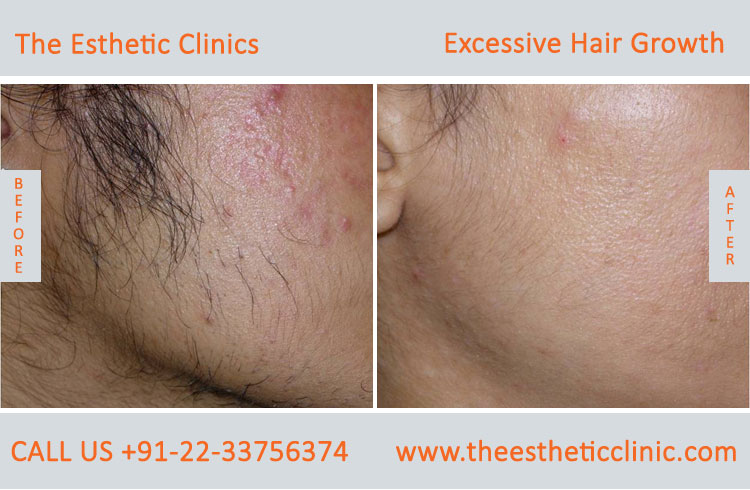 Excessive Hair Growth Removal Treatment before after photos in mumbai india (11)